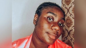 Hirsutism: Chidube's journey to embracing excessive hair growth from PCOS