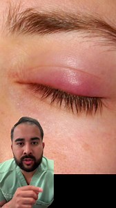 860K views · 4.9K reactions | Do you get this on your eye? #eyeinfection #eyepain #stye #chalazion #doctorreacts #physician #medicine #medical #doctor #eyeredness #eyelids #styes #styetreatment | Inside Anesthesia | Facebook