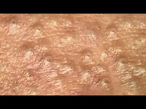Deep blackhead extraction Cystic acne & pimple popping #53