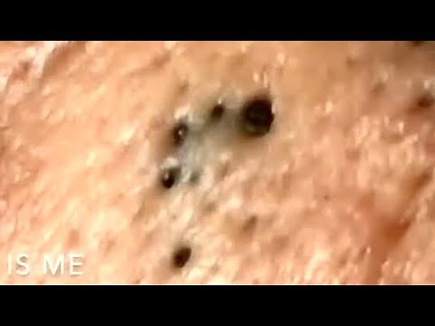Big blackheads.
