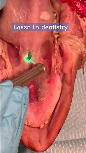 Laser In Dentistry frenectomy
