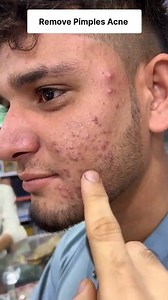 1M views · 5.3K reactions | Remove Pimples Acne Naturally at Home | Get Clear Spotless Skin ✨ Pimples Removal Tips #pimples #acne #skincare #clearskin #beauty #reelschallenge | Health Beauty Treat | Facebook