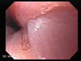 Barrett's Esophagus of long segment -magnifying biopsy (7 of 24) • Video • MEDtube.net