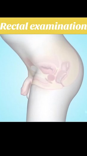 Rectal Examination 3D Medical Procedure: Understanding the Process