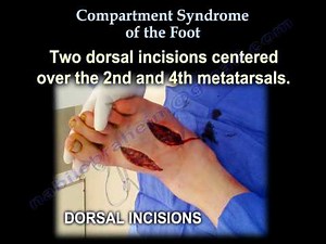 Foot Compartment Syndrome - Everything You Need to Know - Dr. Nabil Ebraheim