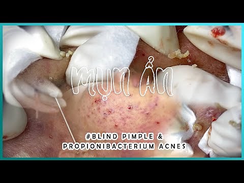 Big Cystic Acne Blackheads Extraction Blackheads & Milia, Whiteheads Removal Pimple Popping