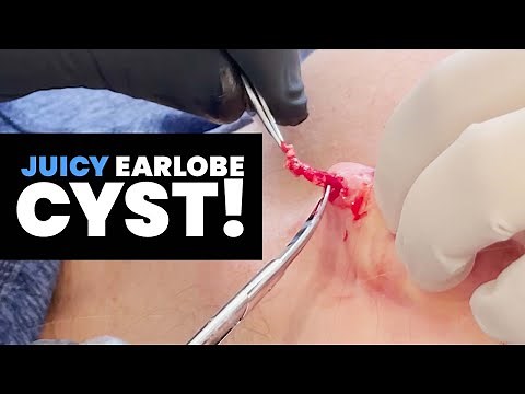 JUICY EARLOBE CYST!