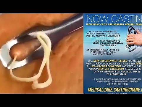 Eschar's, String Cheese Zits and Cyst Removal! Pimple Popping on TV