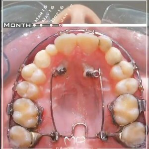 Way Down They Go! . Canines teeth 醴 often lose their path of...