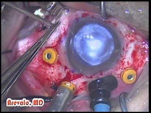 Argus II - Retinal Implant - Bionic Eye Dr. Fernando Arevalo First Argus II Surgery in Middle East