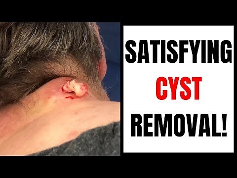SATISFYING CYST REMOVAL!