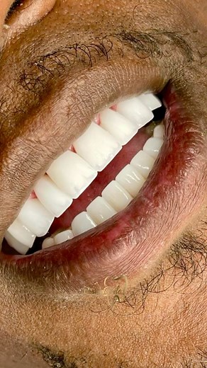 Say goodbye to your gold veneers and embrace a smile makeover with porcelain design. 🔥♥️ | Dental Design Smile