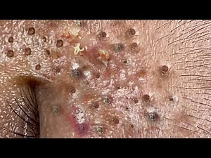 Blackhead Removal With Sac Dep Spa @100074382