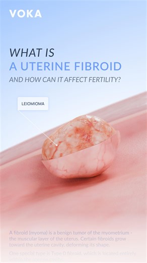 VOKA 3D Anatomy & Pathology on Instagram: "What is a uterine fibroid and how can it affect fertility? A fibroid (myoma) is a benign tumor of the myometrium - the muscular layer of the uterus. Certain fibroids grow toward the uterine cavity, deforming its shape. One special type is Type 0 fibroid, which is located entirely within the uterine cavity. How can fibroids cause problems? 🔻 Abnormal uterine bleeding – distortion of the cavity can disrupt normal menstrual flow. 🔻 Infertility – fibroids