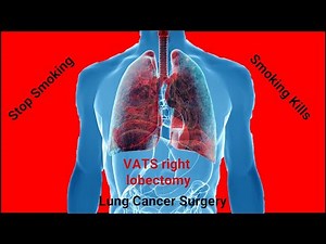 Lung Cancer Surgery | Video-assisted Thoracoscopic Surgery (VATS) right lower lobectomy