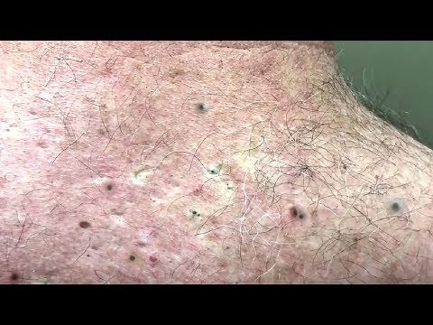 Remove blackheads on back | How to remove blackheads on back