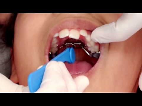 Palate Expander Turning (Activation)
