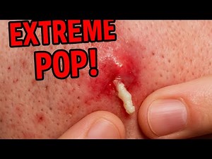 Massive Pimple Explosion 🤯 | So Gross Yet So Satisfying