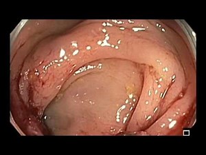 Colonoscopy: Sigmoid colon cancer • Video • MEDtube.net