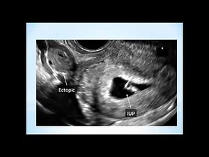Heterotopic Pregnancy