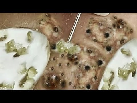 Deep blackhead extraction Cystic acne & pimple popping #27
