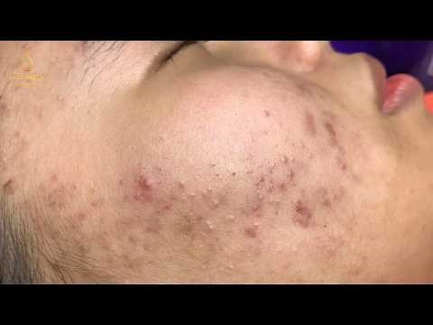 dispel worries about acne_spa loan nguyen (61) | Loan nguyen