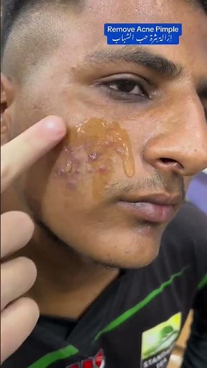 Glow & Clean Anti Acne Serum #ameenbeautytips #youtubeshorts