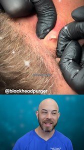 Watch out for this MASSIVE cyst pop on the neck! (@blackheadpurger on TT) #cyst #satisfying | Dr. Dustin Portela, Dermatologist
