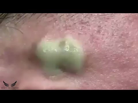 Severe Cystic Acne Blackheads Removal - Inflammatory Acne - Spa Pimple Popping Extraction | #033