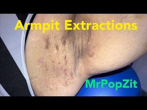 Armpit (axillae) extractions. Blackheads, whiteheads. Oxidized Keratin Plugs in pores removed.