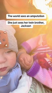 Twin Love After Amniotic Band Syndrome: Sibling Bond with Limb Difference