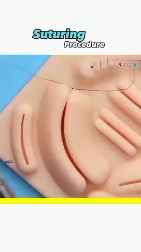 DM 📩 for Paid Promotion. . . #sutures #suture #suturepractice #sutureremoval #suturekit #suturepad #suturing #woundcare #woundhealing #WoundCareIsEssential #reelsfbシ #reelsfypシ #reelsvideo #CR7GOAT #cr7fans #fashionable #fashionphotography #fashionblogger #fashionforward #fashion #fahionstyle #trendingreels #nerveimpulseconduction #instagramreel #openpnemothorax #reelitfeelit #nervepainrelief #medical | 𝐃𝐫. 𝐃𝐢𝐥𝐚𝐰𝐚𝐫 𝐤𝐡𝐚𝐧