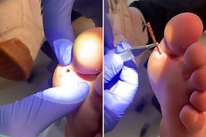 Video of a monster splinter bursting out of man's foot will make you jump