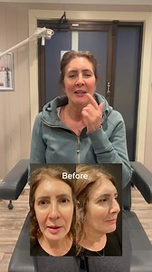 Patient was considering of getting a surgical procedure, but after getting filler placed in her nasolabial folds, cheeks, and jawline with Dr. Berkowitz she is so happy with the results she doesn't feel it is necessary!😊📱Call 586-254-7692 to schedule an appointment. | Accents Cosmetic Surgery and Medical Spa