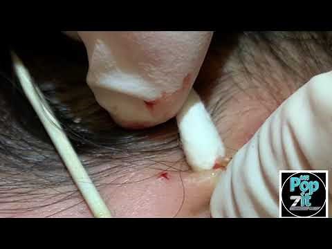 Your new favorite extraction video part 1. Blackheads, whiteheads, milia. Over 20 minutes of pops.