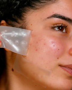 Treat your acne with these simple and easy hacks! | Beauty Studio