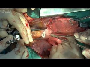 Open Left Upper Lobectomy in Complicated Patient • Video • MEDtube.net