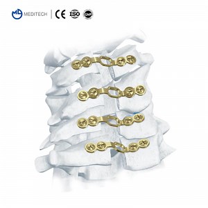 [Hot Item] Meditech Hot Sales Orthopedic Medical Implants Plate Fixation System Titanium Posterior Cervical Laminoplasty Plate