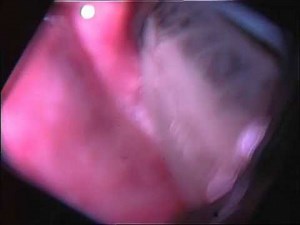 AIRTRAQ ENDO CAM + ESCHMANN INSIDE ETE