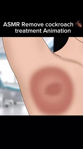 Effective Cockroach Removal ASMR Treatment Animation