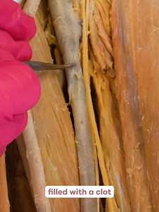 😮 Blood clots in veins can grow over two feet long — and you might not even feel it happening. DVT (Deep Vein Thrombosis) is a clot that forms in the deep veins, most commonly in the legs or pelvis. And unlike arterial clots — which immediately cut off oxygen-rich blood to tissues — venous clots don't cause that same instant emergency. Here's why: Veins carry deoxygenated blood back to the heart, and the venous system has far more collateral pathways than arteries. So when a clot forms in a dee