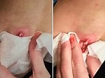 Gruesome moment giant cyst under woman's armpit is popped