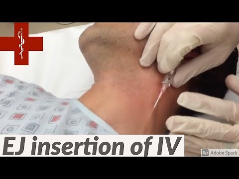 How to do an EJ IV insertion