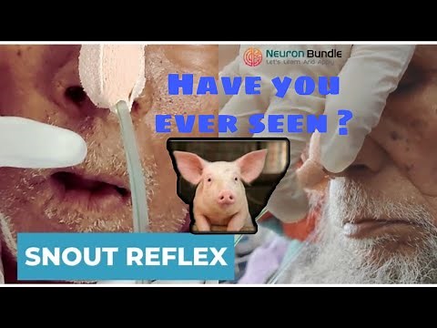 SNOUT Reflex #Test // Orbicularis Oris Reflex #PositiveReflex #Parkinson's-disease #medschool