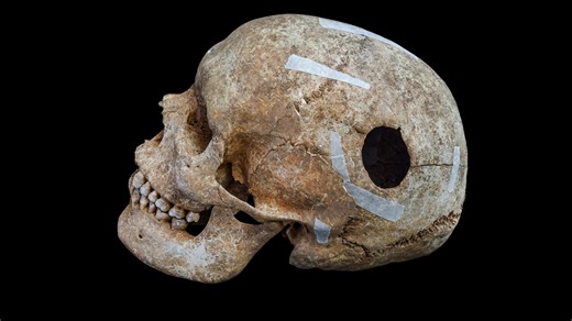 Medieval “Giant” with Trepanned Skull Discovered in Mass Grave - Medievalists.net