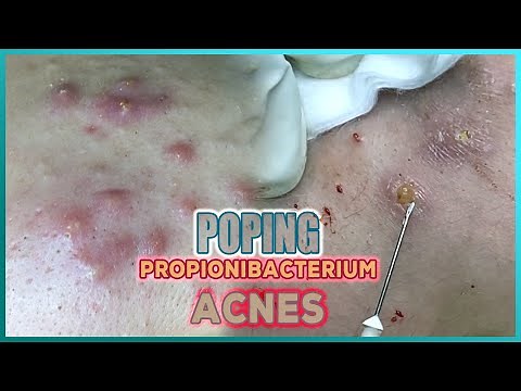Big Cystic Acne Blackheads Extraction Blackheads & Milia, Whiteheads Removal Pimple Popping
