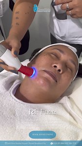What is RF FACE? RF (Radiofrequency) face treatment is a non-invasive cosmetic procedure that uses radiofrequency energy to heat the deeper layers of the skin. This heat stimulates collagen production, tightens the skin, reduces wrinkles, and can improve overall skin texture. It is commonly used to treat sagging skin, fine lines, and other signs of aging, especially around the face and neck. Since it is non-surgical, there is minimal downtime, making it a popular option for those seeking skin re