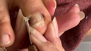 Remove the corner of the toenail and cut the skin | Ingrown toenails