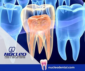 You might need a root canal if your tooth pulp, which is composed of nerves and blood vessels, becomes infected or damaged. During the procedure, the pulp is removed, and the inside of your tooth is cleaned and sealed. . Phone: 915 308 0101 nucleodental.com . #NucleoDental #ElPasoTx #CiudadJuarez #NewMexico #dentalclinicnearme #oralcare #oralhealth #dentaltourism #dentaltourismmexico #dentalimplantsmexico #dentalimplantsjuarez #bestdentalserviceintown #cosmeticdentistry #dentalservice #orthodont