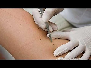 SKIN BIOPSY - DERMATOLOGICAL SURGERY